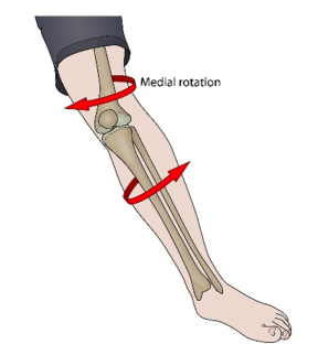 Anterior Cruciate Ligament (ACL) & Medial Collateral Knee Ligament (MCL)  Injuries