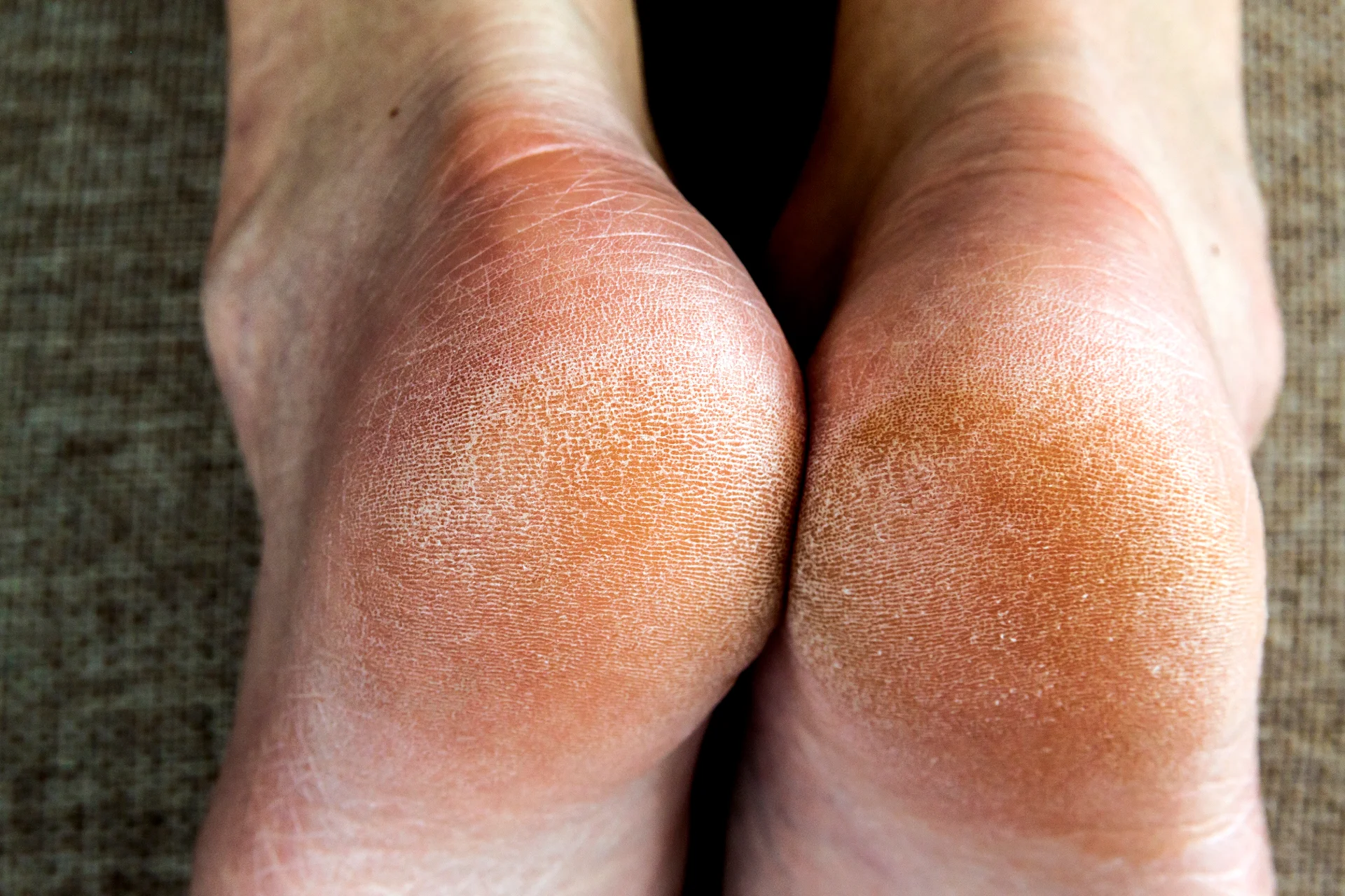 cracked heels showing extreme dryness close up 2026 03 16 02 10 49 utc