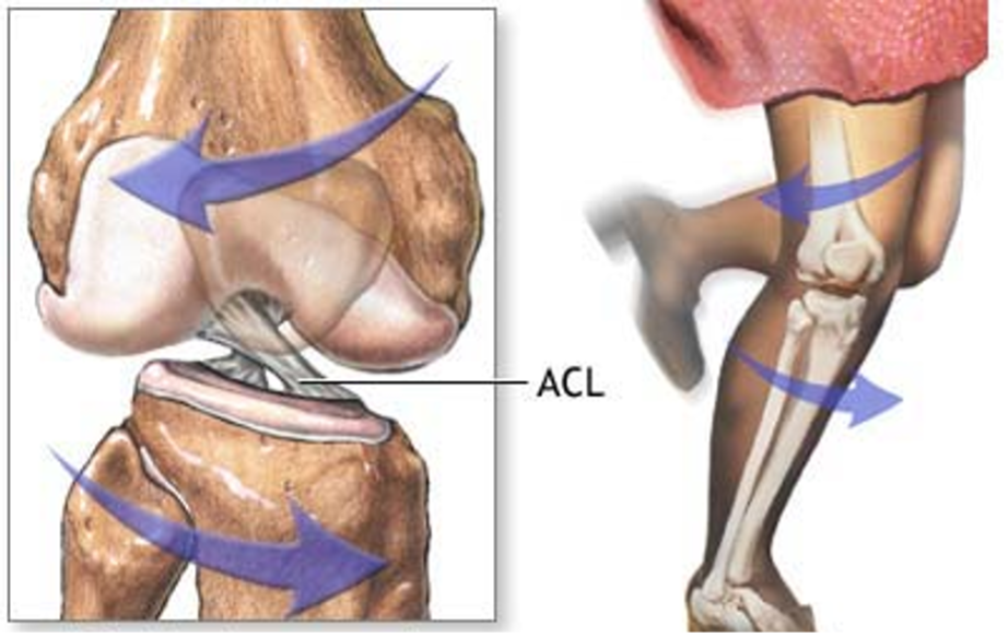 Anterior Cruciate Ligament (ACL) Injuries: What You Need to Know 1 ACL MOI
