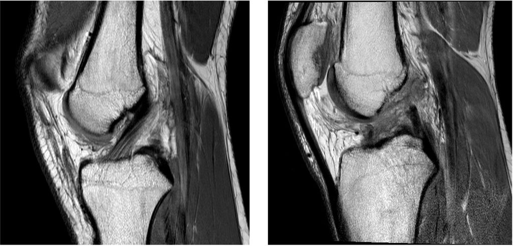 Anterior Cruciate Ligament (ACL) Injuries: What You Need to Know 2 ACL MRI 1024x491 1